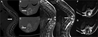 Surgical treatment of severe thoracic <mark class="highlighted">kyphosis</mark> and neurological deficit in a patient with Gorham–Stout syndrome: A case report and literature review